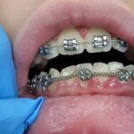 What Happens If You Lose Insurance During Braces