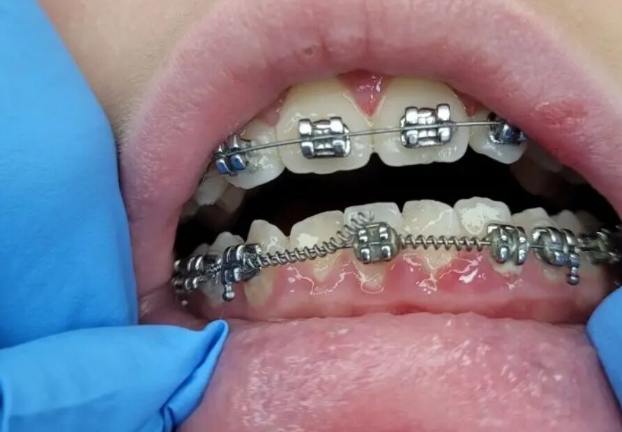 What Happens If You Lose Insurance During Braces